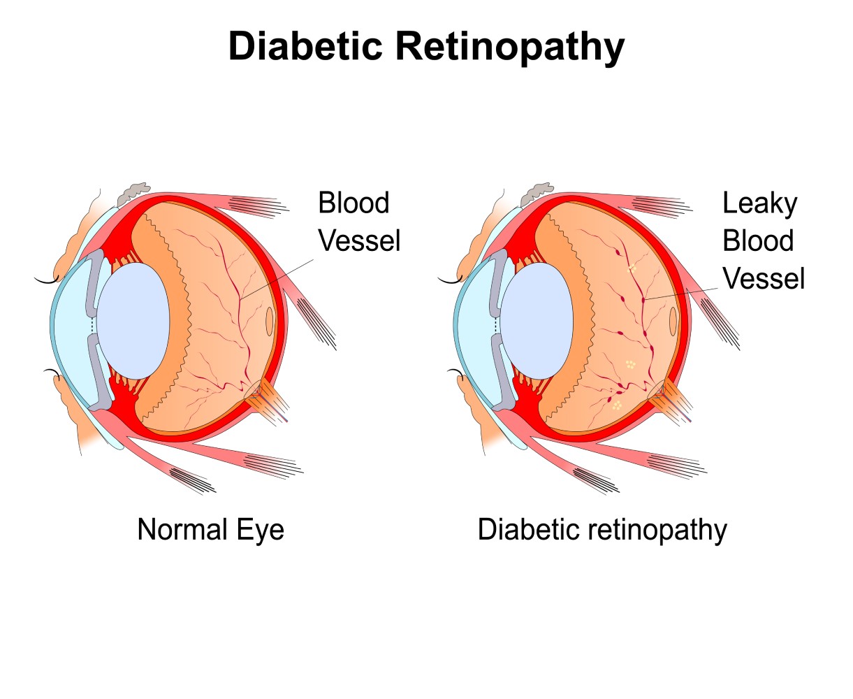 Diabetic Eye Diagram